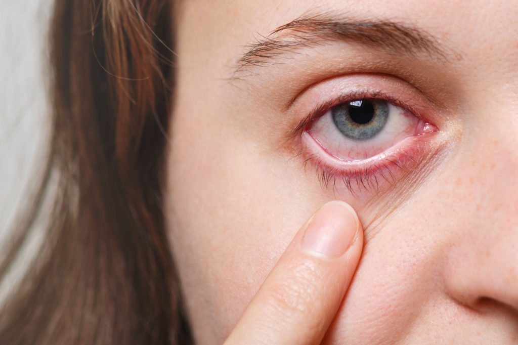 Conjuntivitis